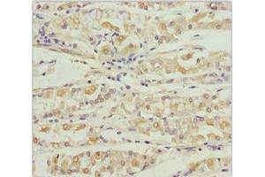 Immunohistochemistry of paraffin-embedded human gastric cancer using ABIN7164013 at dilution of 1:100 (KCNS3 anticorps  (AA 1-180))