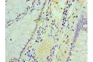 Immunohistochemistry of paraffin-embedded human colon cancer using ABIN7156671 at dilution of 1:100 (IFIT3 anticorps  (AA 1-490))