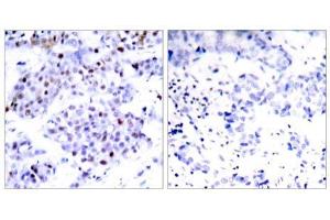 Immunohistochemical analysis of paraffin-embedded human breast carcinoma tissue using STAT6 (Ab-645) antibody (E021051). (STAT6 anticorps)