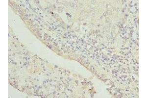 Immunohistochemistry of paraffin-embedded human lung cancer using ABIN7172352 at dilution of 1:100 (TRAPPC1 anticorps  (AA 1-260))
