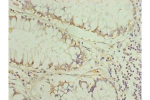 Immunohistochemistry of paraffin-embedded human colon cancer using ABIN7151254 at dilution of 1:100 (TRIM31 anticorps  (AA 186-425))