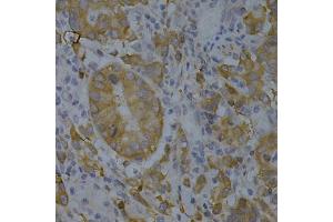 Immunohistochemistry of paraffin-embedded human gastric cancer using BIN1 Antibody (ABIN5970905) at dilution of 1/200 (40x lens). (BIN1 anticorps)