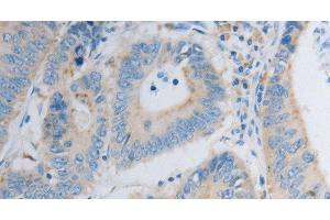 Immunohistochemistry of paraffin-embedded Human colon cancer using PDX1 Polyclonal Antibody at dilution of 1:30 (PDX1 anticorps)