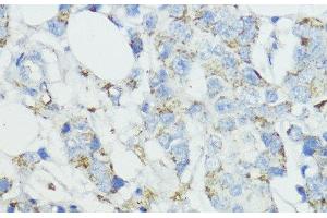 Immunohistochemistry of paraffin-embedded Human mammary cancer using SOD3 Polyclonal Antibody at dilution of 1:100 (40x lens). (SOD3 anticorps)