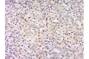 Paraformaldehyde-fixed, paraffin embedded human cervical carcinoma tissue, Antigen retrieval by boiling in sodium citrate buffer(pH6) for 15min, Block endogenous peroxidase by 3% hydrogen peroxide for 30 minutes, Blocking buffer (normal goat serum) at 37°C for 20min, Antibody incubation with Rabbit Anti-CCDC58 Polyclonal Antibody, Unconjugated  at 1:500 overnight at 4°C, followed by a conjugated secondary and DAB staining