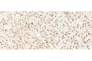 Immunohistochemistry of paraffin-embedded Human liver cancer tissue using RBX1 Polyclonal Antibody at dilution of 1:50(x200) (RBX1 anticorps)