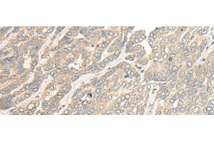 Immunohistochemistry of paraffin-embedded Human liver cancer tissue using RSU1 Polyclonal Antibody at dilution of 1:30(x200)