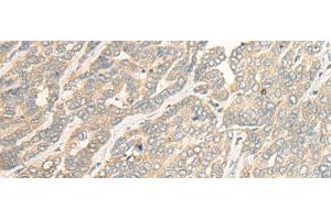 Immunohistochemistry of paraffin-embedded Human liver cancer tissue using RSU1 Polyclonal Antibody at dilution of 1:30(x200) (RSU1 anticorps)