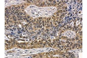 c-Myb Mouse Monoclonal Antibody at 1/100 staining human lung cancer and adjacent non-tumor tissue by IHC-P. (MYB anticorps  (C-Term))