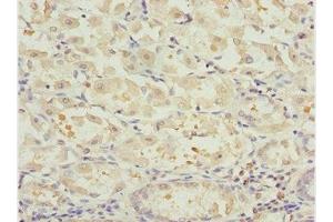 Immunohistochemistry of paraffin-embedded human gastric cancer using ABIN7161725 at dilution of 1:100