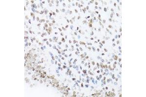 Immunohistochemistry of paraffin-embedded human uterine cancer using NFKB2 Antibody.
