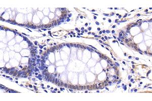 Detection of MMP7 in Human Colon Tissue using Polyclonal Antibody to Matrix Metalloproteinase 7 (MMP7)