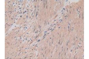 Detection of MYL2 in Human Rectum Cancer Tissue using Polyclonal Antibody to Myosin Light Chain 2 (MYL2)