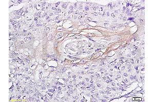 Formalin-fixed and paraffin embedded human esophageal carcinoma labeled with Anti-Integrin Alpha X/CD11c Polyclonal Antibody, Unconjugated (ABIN741285) at 1:200 followed by conjugation to the secondary antibody and DAB staining