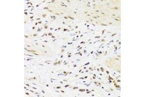 Immunohistochemistry of paraffin-embedded human breast cancer using SUMO4 Antibody.