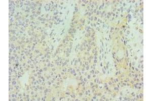 Immunohistochemistry of paraffin-embedded human breast cancer using ABIN7155529 at dilution of 1:100
