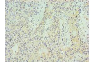 Immunohistochemistry of paraffin-embedded human breast cancer using ABIN7155529 at dilution of 1:100 (SUV39H2 anticorps  (AA 201-410))