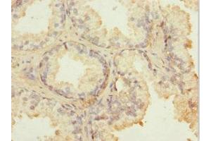 Immunohistochemistry of paraffin-embedded human prostate cancer using ABIN7143006 at dilution of 1:100
