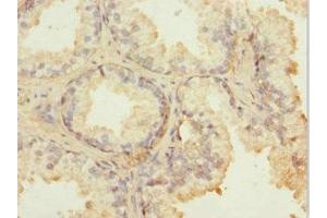 Immunohistochemistry of paraffin-embedded human prostate cancer using ABIN7143006 at dilution of 1:100 (FIBP anticorps  (AA 1-364))