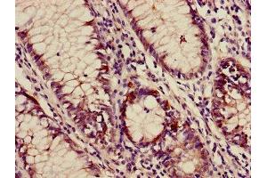 Immunohistochemistry of paraffin-embedded human colon cancer using ABIN7144378 at dilution of 1:100 (AP3M2 anticorps  (AA 1-273))