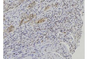 ABIN6272660 at 1/100 staining Human lung cancer tissue by IHC-P. (BPIFA1 anticorps  (Internal Region))