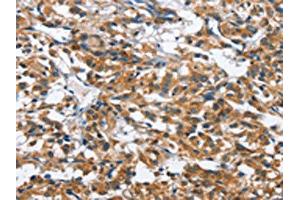 The image on the left is immunohistochemistry of paraffin-embedded Human thyroid cancer tissue using ABIN7128679(BPI Antibody) at dilution 1/50, on the right is treated with fusion protein. (BPI anticorps)
