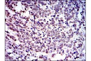 Immunohistochemical analysis of paraffin-embedded cervical cancer tissues using NEDD8 mouse mAb with DAB staining.