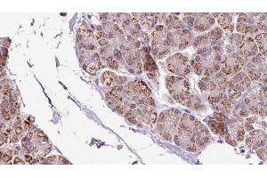 ABIN6273236 at 1/100 staining Human pancreas cancer tissue by IHC-P. (EIF2B1 anticorps  (Internal Region))