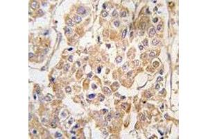 IHC analysis of FFPE human breast carcinoma tissue stained with the IKKE antibody (IKKi/IKKe anticorps  (AA 686-716))