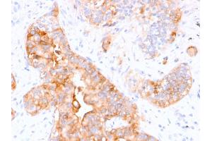 Formalin-fixed, paraffin-embedded human Colon Carcinoma stained with CEA Mouse Monoclonal Antibody (CEA31).