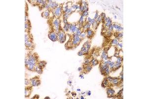 Immunohistochemistry of paraffin-embedded human liver cancer using GLUD2 antibody at dilution of 1:100 (x40 lens). (GLUD2 anticorps)