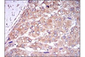 Immunohistochemical analysis of paraffin-embedded liver cancer tissues using CASP8 mouse mAb with DAB staining.