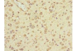 Immunohistochemistry of paraffin-embedded human glioma using ABIN7163444 at dilution of 1:100