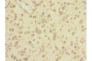 Immunohistochemistry of paraffin-embedded human glioma using ABIN7163444 at dilution of 1:100 (PIEZO1 anticorps  (AA 2230-2420))