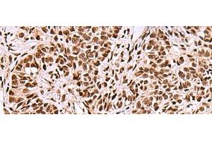 Immunohistochemistry of paraffin-embedded Human ovarian cancer tissue using FOXK2 Polyclonal Antibody at dilution of 1:50(x200) (Forkhead Box K2 anticorps)
