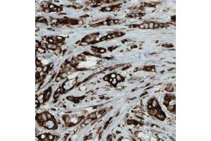 Immunohistochemical staining (Formalin-fixed paraffin-embedded sections) of human breast cancer with MTDH monoclonal antibody, clone CL0397  shows strong cytoplasmic immunoreactivity in cancer cells. (MTDH anticorps)