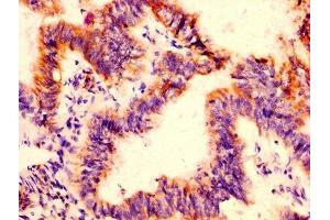 IHC image of ABIN7156043 diluted at 1:500 and staining in paraffin-embedded human colon cancer performed on a Leica BondTM system. (FcRn anticorps  (AA 24-297))