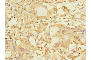 Immunohistochemistry of paraffin-embedded human pancreatic cancer using ABIN7146024 at dilution of 1:100 (SPAG9 anticorps  (N-Term))