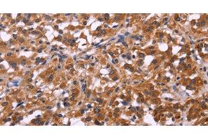 Immunohistochemistry of paraffin-embedded Human thyroid cancer tissue using SPATA7 Polyclonal Antibody at dilution 1:30 (SPATA7 anticorps)