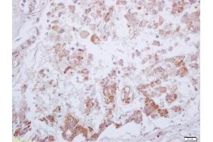 Formalin-fixed and paraffin embedded human liver carcinoma labeled with Anti-Phospho-PKM2 (Tyr105) Polyclonal Antibody, Unconjugated (ABIN744773) at 1:200 followed by conjugation to the secondary antibody and DAB staining (PKM2 anticorps  (pTyr105))
