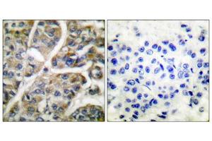 Immunohistochemical analysis of paraffin-embedded human breast carcinoma tissue using Granzyme B antibody (ABIN2843546).