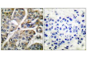 Immunohistochemical analysis of paraffin-embedded human breast carcinoma tissue using Granzyme B antibody (ABIN2843546). (GZMB anticorps  (N-Term))