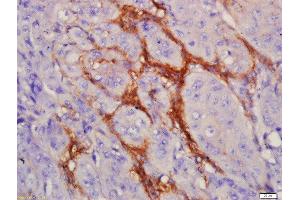Formalin-fixed and paraffin embedded human laryngocarcinoma labeled with Anti-EGFRvIII Polyclonal Antibody, Unconjugated  at 1:200 followed by conjugation to the secondary antibody and DAB staining (EGFRviii anticorps  (AA 1-50))