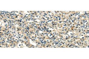 Immunohistochemistry of paraffin-embedded Human prostate cancer using DLAT Polyclonal Antibody at dilution of 1/40