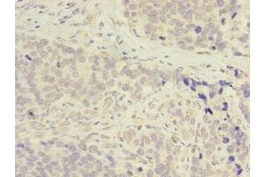 Immunohistochemistry of paraffin-embedded human gastric cancer using ABIN7143283 at dilution of 1:100