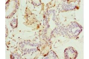 Immunohistochemistry of paraffin-embedded human breast cancer using ABIN7165308 at dilution of 1:100