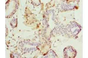 Immunohistochemistry of paraffin-embedded human breast cancer using ABIN7165308 at dilution of 1:100 (DR1 anticorps  (AA 1-176))