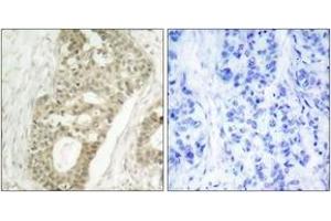 Immunohistochemistry analysis of paraffin-embedded human breast carcinoma, using PKC delta (Phospho-Ser645) Antibody.
