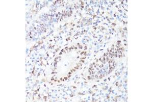 Immunohistochemistry of paraffin-embedded human appendix using P-MYC-S62 antibody (ABIN3019544, ABIN3019545, ABIN3019546 and ABIN6225456) at dilution of 1:100 (40x lens). (c-MYC anticorps  (pSer62))