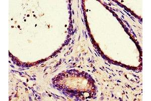 Immunohistochemistry of paraffin-embedded human prostate cancer using ABIN7146508 at dilution of 1:100
